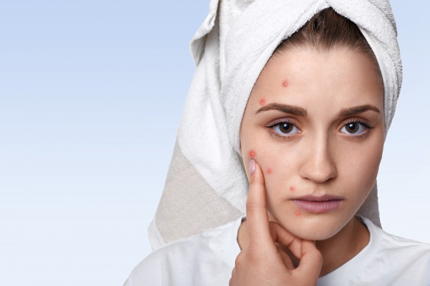 TN beauté : Quelques petits gestes pour lutter contre la poussée d’acné