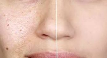 TN Beauté : 5 aliments pour se débarrasser des points noirs !