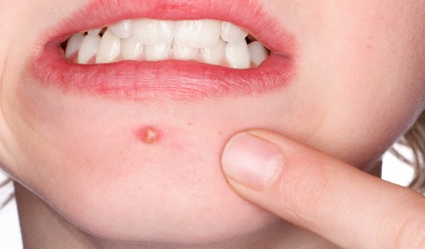 TN beauté : Évitez ces 4 aliments, ils vous donnent des boutons  !