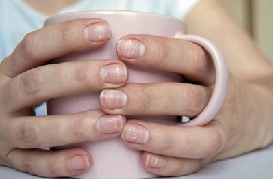 Les taches blanches sur les ongles : Causes et solutions