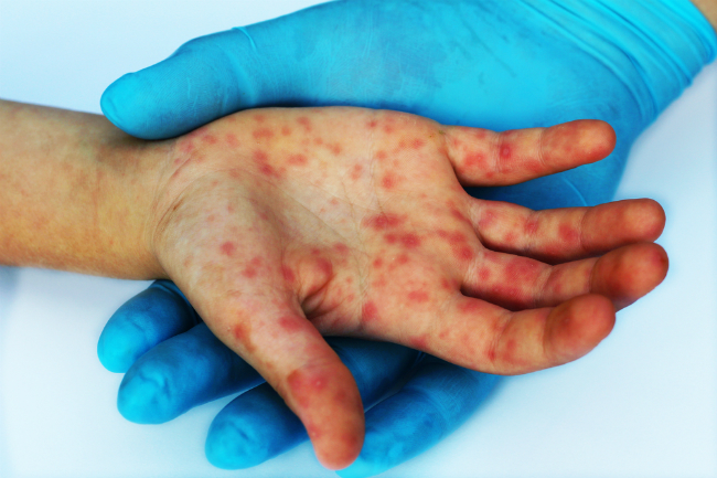 Tunisie: Aucun cas de variole du singe n’est enregistré pour le moment