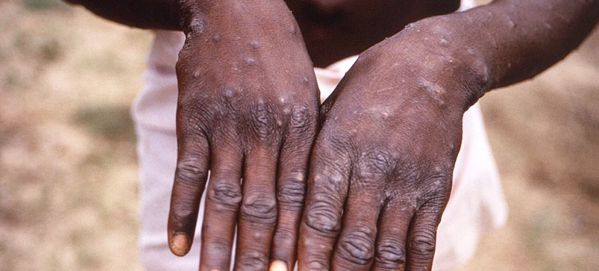 OMS : La variole des singes ne se transformera pas en pandémie