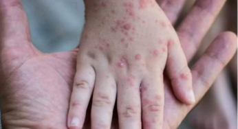 RDC: Le Mpox continue de se propager dans les camps de déplacés