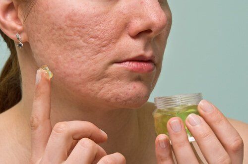 TN Beauté : Comment faire disparaître les cicatrices d’acné ?
