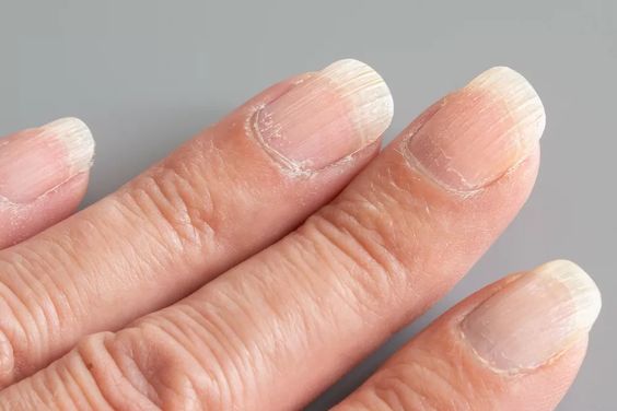 TN Beauté : Ongles striés : comment soigner des stries sur les ongles ?