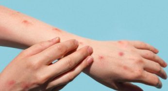 Variole du singe: La libye déclare l’état d’urgence sanitaire