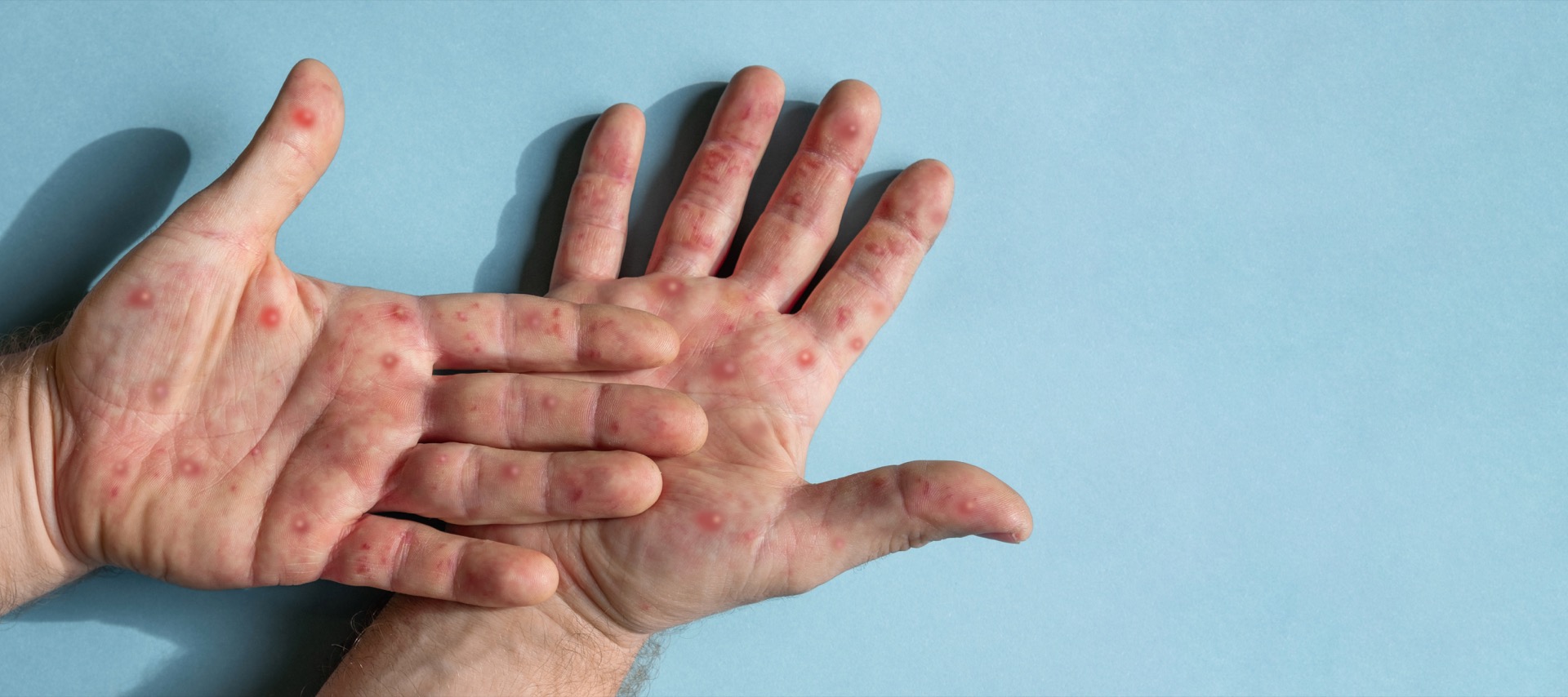 Mpox : L’OMS maintient son plus haut niveau d’alerte